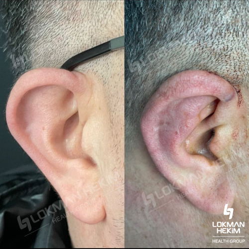 Ear correction surgery (Otoplasty) Before / After photo